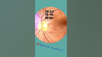 Smartphone Fundus Videography | Fundus Photography | Short Video 20