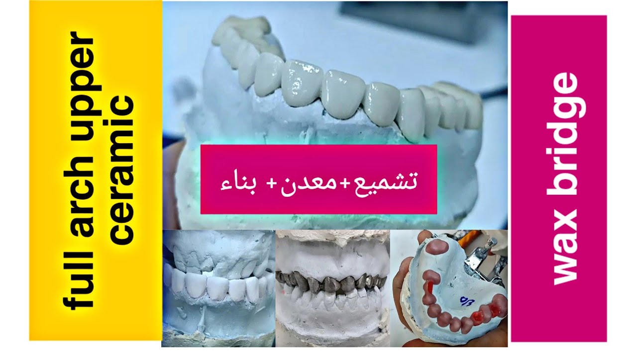 Full arch upper ceramic wax bridge تشميع +معدن + بناء