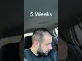 Hair transplant process  week by week  3 months