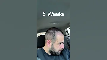 Hair Transplant Process - Week by Week - 3 Months