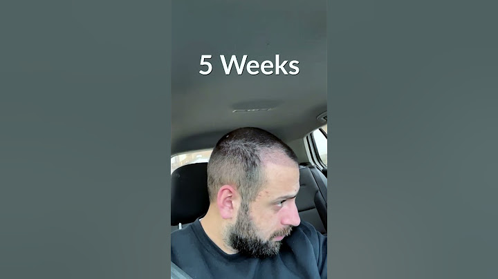 Hair Transplant Process - Week by Week - 3 Months