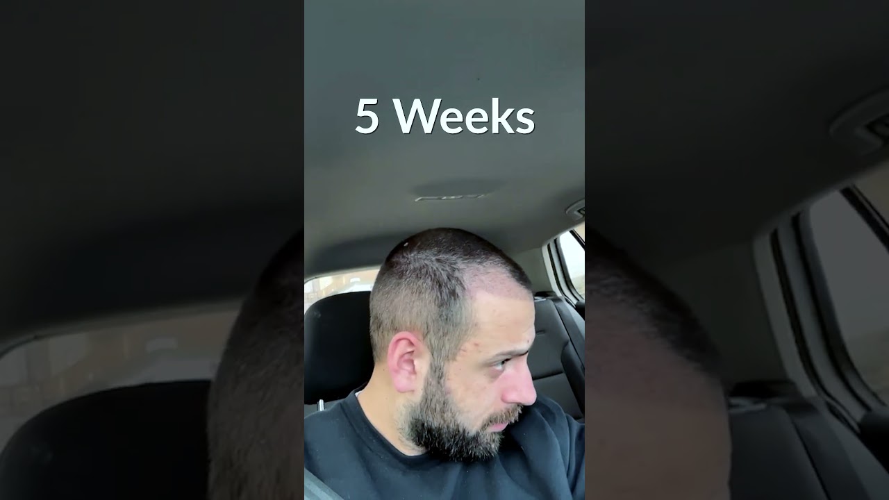 Hair Transplant Process - Week by Week - 3 Months