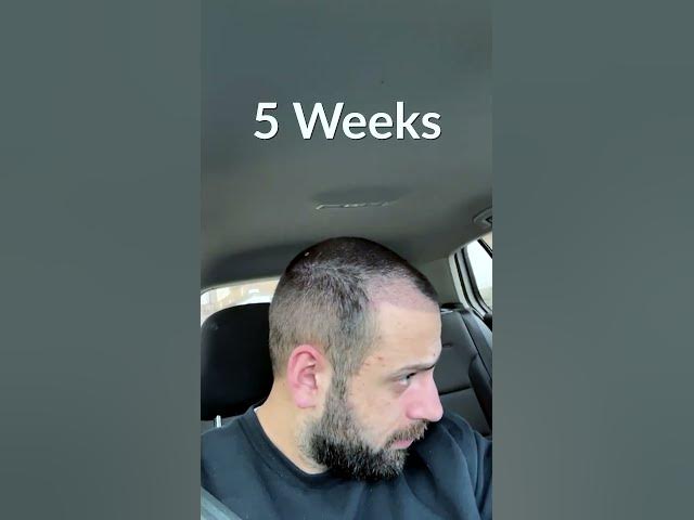 Hair Transplant Process - Week by Week - 3 Months