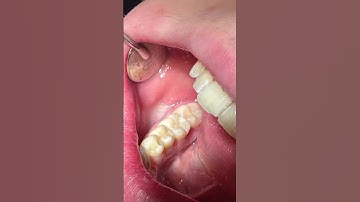 Did you get your hands on Strata-G Matrix System? 🦷✨