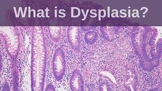 What is Dysplasia?  Pathology mini tutorial