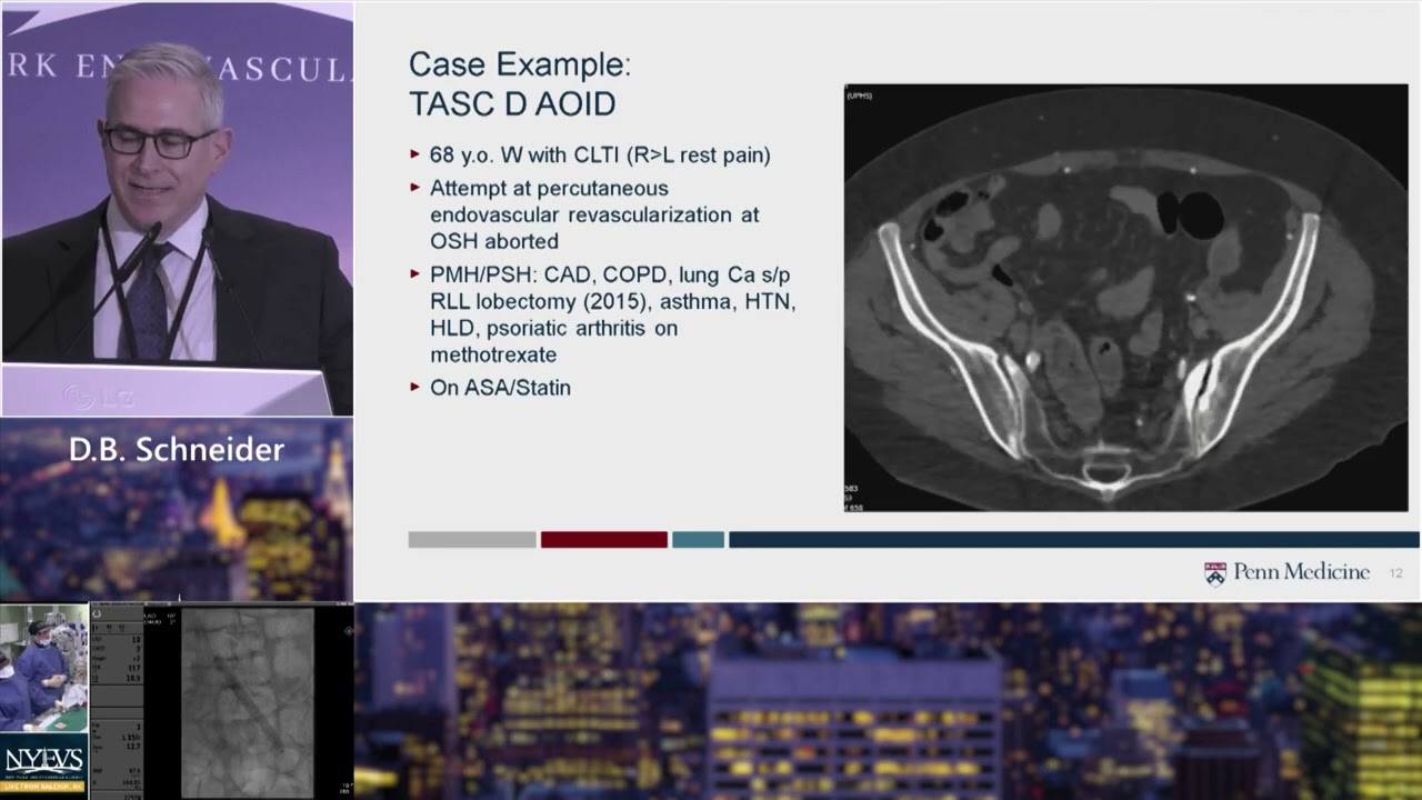 Endovascular Technique for Bilateral Ostial Iliac Disease with Distal Aortic Involvement   D  B Schn