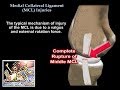 Medial Collateral Ligament Injuries - Everything You Need To Know - Dr. Nabil Ebraheim