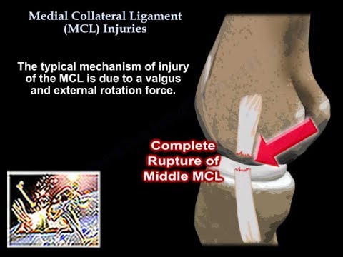 Medial Collateral Ligament (MCL) / Lateral Collateral Ligament (LCL)  Injuries: - Primal Physiotherapy