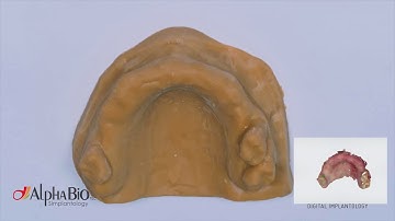 IMMEDIATE LOADING GUIDED SURGERY DOUBLE ARCH dr.Giampiero Ciabattoni Digital Implantology Video