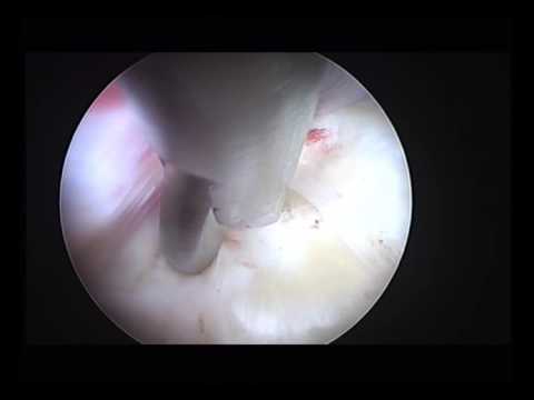 GRAPHIC CONTENT WARNING: Images of a Surgical Procedure] John J. Carbone, MD, is a board-certified o. 