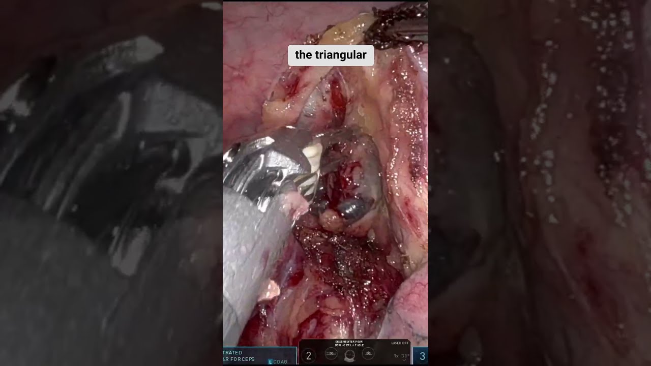 Robotic Right Upper Lobectomy Without Dissecting the Superior Pulmonary Vein: A Multiportal Approach