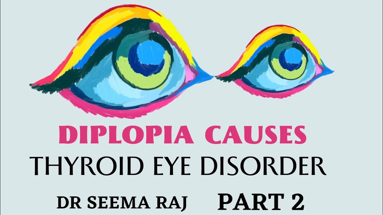 Causes of Diplopia Part 2 Thyroid Eye Disorder By Dr Seema Raj - YouTube