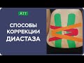 Диастаз прямых мышц живота. Эстетическое тейпирование. Упражнения при диастазе. Мастер класс.