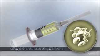 Autologous Conditioned Plasma (ACP)