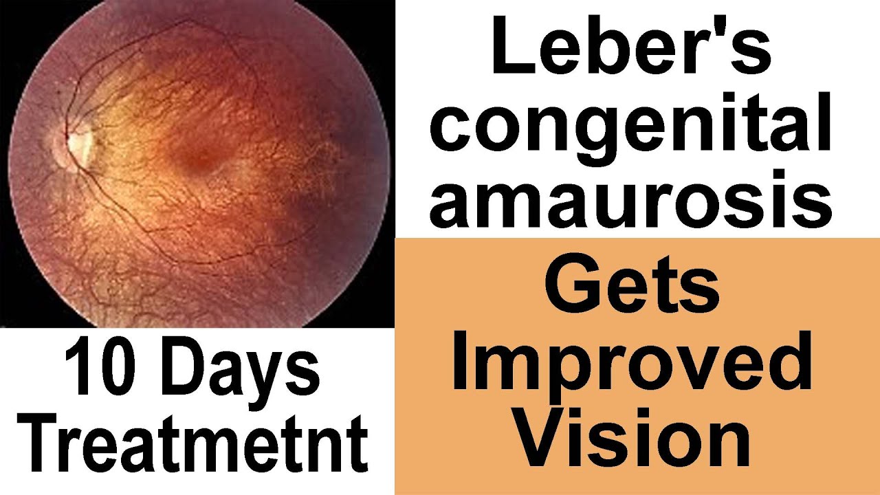 Lebers Congenital Amaurosis