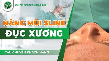 Nâng Mũi Sline - Đục Xương | Bác Sĩ Ngô Mộng Hùng #ngomonghung