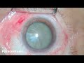 Manual small incision cataract surgery msics