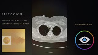 CT assessment - thoracic aortic assessment (some tips on basic evaluation)