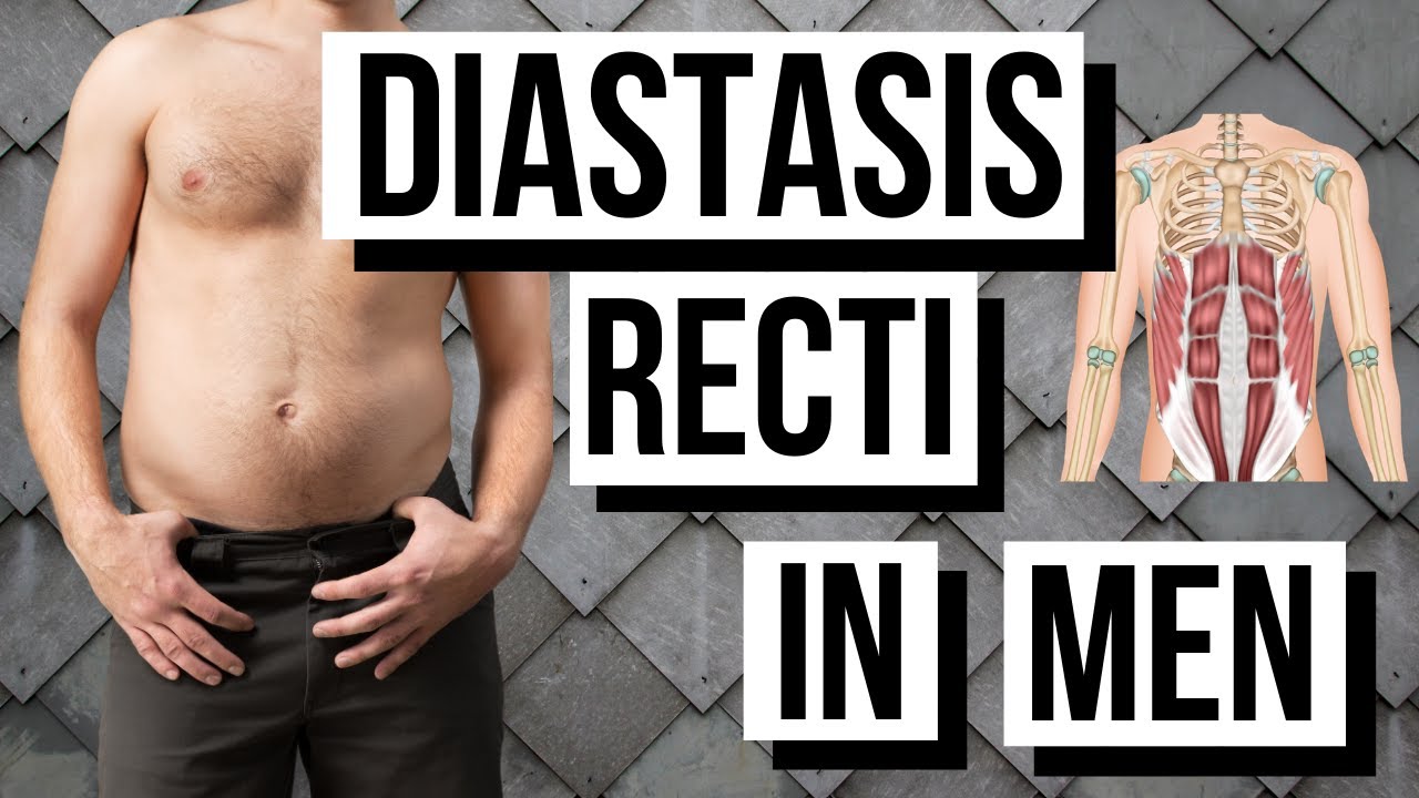 Diastasis Recti In Men Over 35 (Fix Your Belly Bulge!)