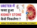 Impacted Ureteral Stone क्या होता है? Symptoms और Treatment | URSL Surgery Explained