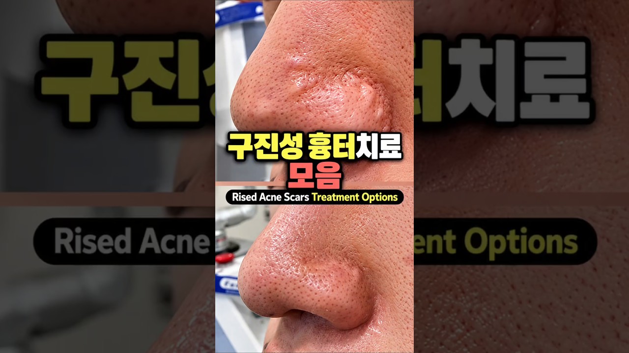 Rised Acne Scars Treatment Options구진성 비후성 흉터 #skincare #acne #vlog