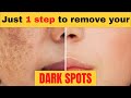 Remove dark spots in just 7 days | 100% Natural | Get rid of uneven skintone |Close Large OPEN PORES
