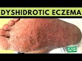 Dyshidrotic Eczema: Trimming Calluses and Loose Skin Of A Highly Inflammatory Skin Condition