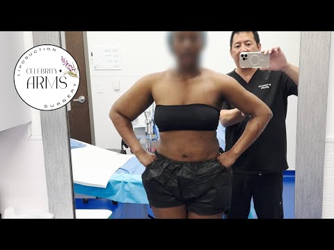 ⚠️ The Truth About Arm Liposuction: What Surgeons Aren’t Telling You 😳 | Celebrity Arms™ Liposuction