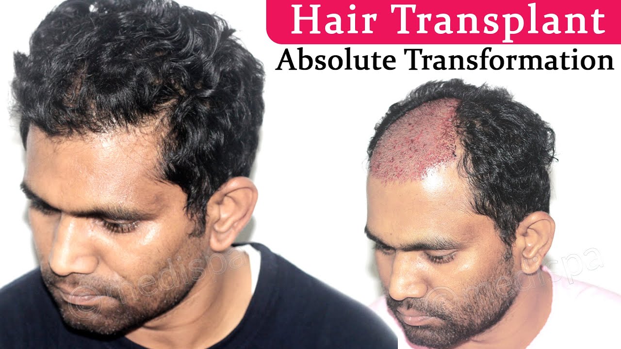 Hair Transplant in Hyderabad & Cost with Results at MEDISPA India Dr