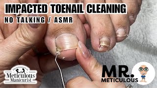 👣How to Fix Ingrown / Impacted Toenails - No Talking👣