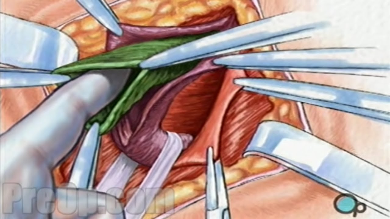 Hernia Repair Inguinal Open Surgery Patient Education YouTube
