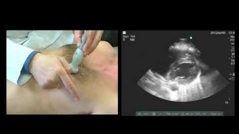 Basic TTE Video Tutorial