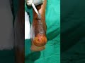 Tendoachiles tear | Tension Band Wiring, Follow up | Physiotherapy | Sutures remvl | Adamya Hosp Vid