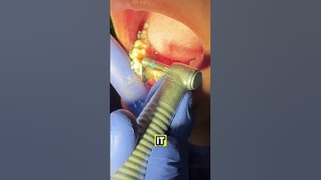 IPR and Braces - Interproximal Reduction - Toothtime Family Dentistry New Braunfels