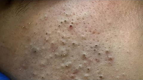 Soko Korean Skincare Routine (For Pimple Marks, Hyper-Pigmentation)