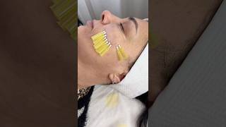 💥Коррекция малярных мешков . #красота