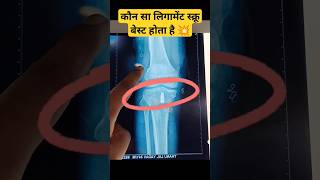 Best Ligament Screw 🔥 सबसे अच्छा कौन सा होता है⁉️