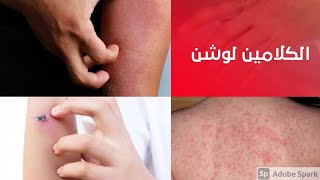 الحل السحري للحكة ولدغ الحشرات و حروق الشمس و حمو النيل  Get Clear Skin with Lacto Calamine Lotion