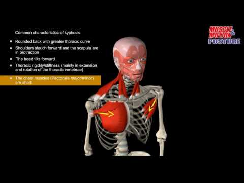 Muscle&Motion POSTURE - Kyphosis - Muscle&Motion POSTURE - Kyphosis