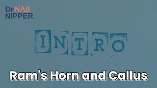 Intro for Friday Feature - May 7th - Mini Ram's Horn Toenail and Calluses