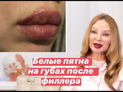 Белые пятна на губах после филлера?