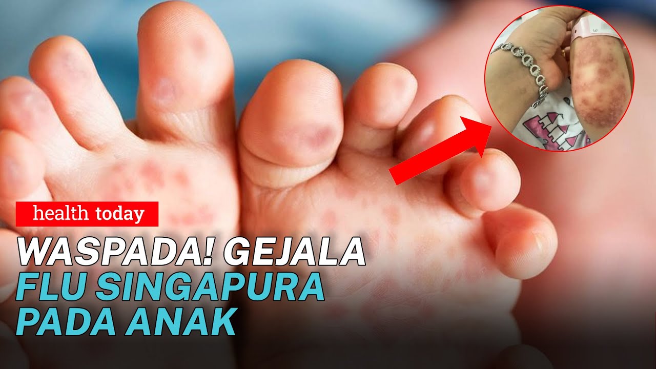 Flu Singapura Rentan Menyerang Anak anak, Kenali Tanda Gejalanya | Health Today #141
