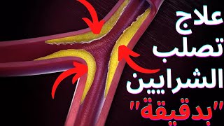 علاج الكولسترول و انسداد الشرايين بدقيقة