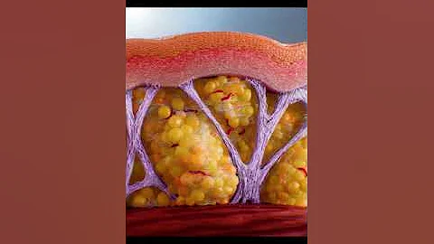 ¿Cuáles son las causas de la celulitis en muslos y nalgas?