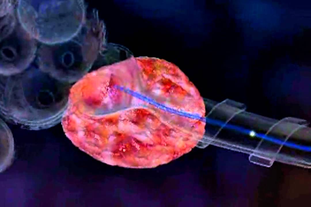 Brachytherapy What is HDR Brachytherapy Video YouTube Brachytherapy What is HDR Brachytherapy Video YouTube