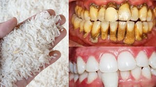 Teeth whitening and tartar removal in 1 minute! Get white teeth like pearls
