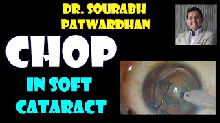 131 The chop of choice in soft cataract- Dr Sourabh Patwardhan -Mechanical chops screenshot 2