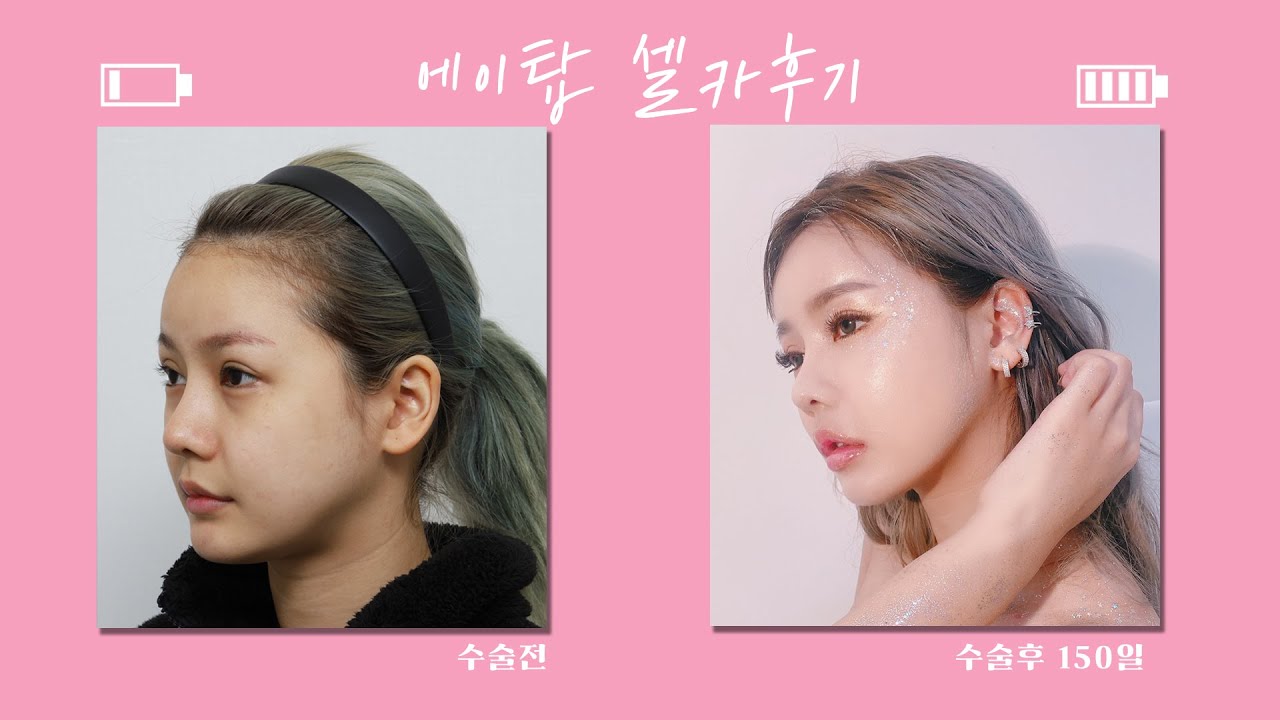 [Эйтоп Гоо сайхны Мэс засал] Бүтэн нүүрний өөх шилжүүлэн суулгах, эзэлхүүнийг нэмэгдүүлж залуу төрхийг бий болгох/Тайландын бүжигчин баталгаажуулсан👍/Эйтоп Гоо сайхны Мэс засал/ATOP plastic surgery/Солонгосын Айта гоо сайхны мэс заслын эмнэлэг