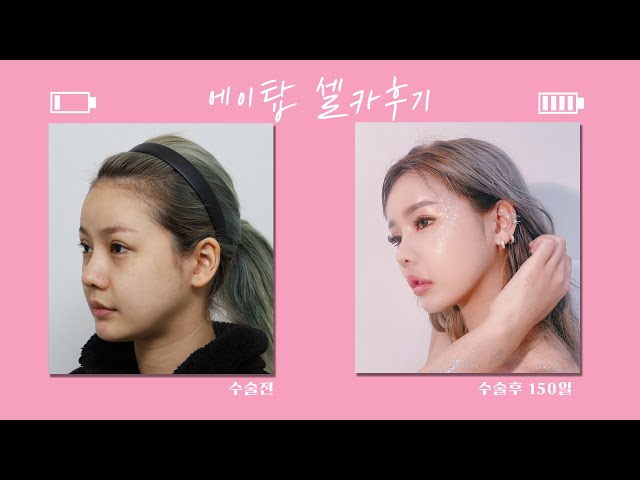 풀페이스 지방이식, 볼륨감을 높인 동안완성/태국 댄서 인증👍/에이탑성형외과/ATOP plastic surgery/韩国爱她整形外科医院