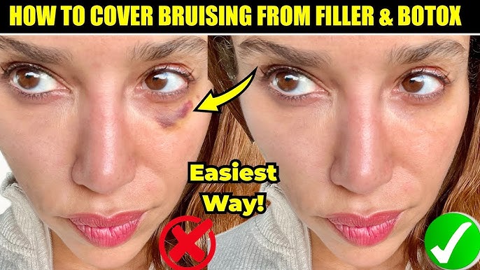 How to Cover a Black Eye With Makeup - Bellatory